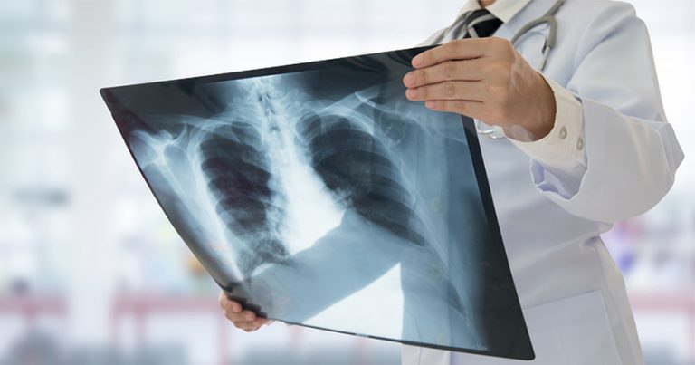 Doctor holding up xray of lungs